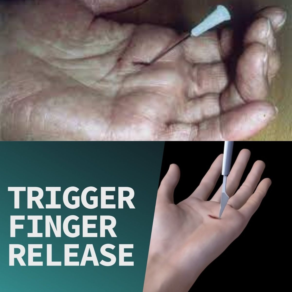 TRIGGER FINGER RELEASE