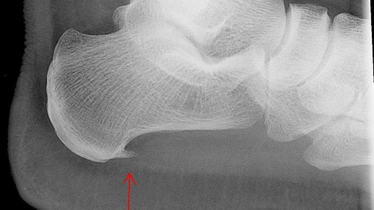 heel-foot-pain-calcaneal spur-https://myjointpaindoctor.com/