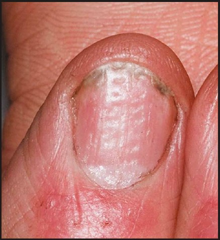 psoriatic arthritis nail piting