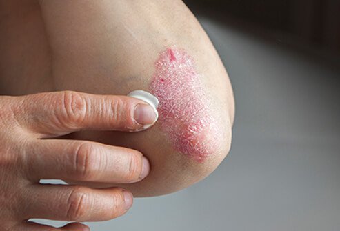 psoriatic arthrits elbow skin involvement.