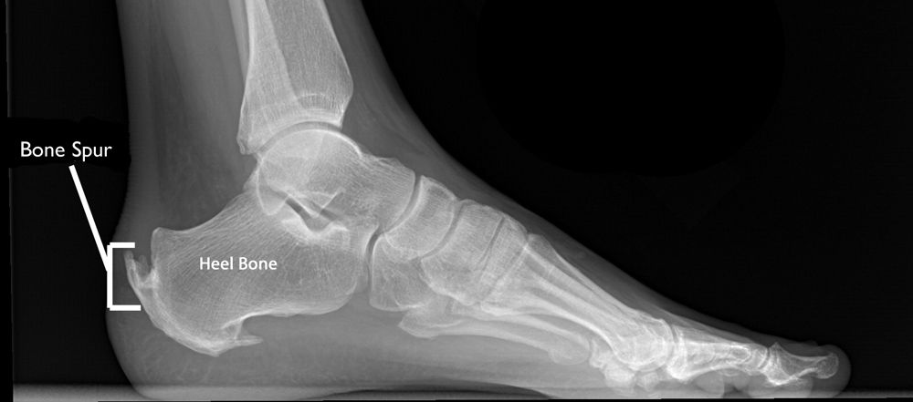 xray heel