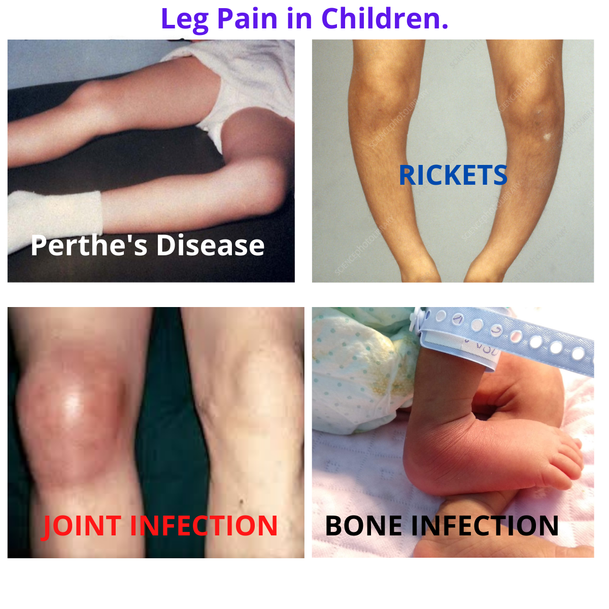 LEG-PAIN IN CHILDREN-SERIOUS-REASONS