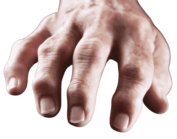 rhuematoid arthritis joint pain doctor
