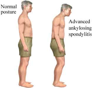 ankylosing spondylosis and text neck syndrome