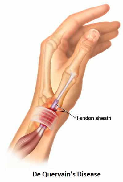 dequervains tenosynovitis