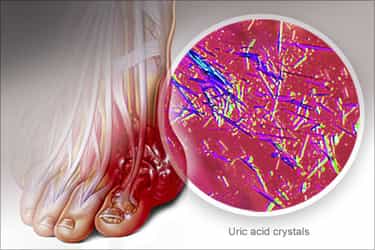 gouty-foot-with-uric-acid-crystals-min