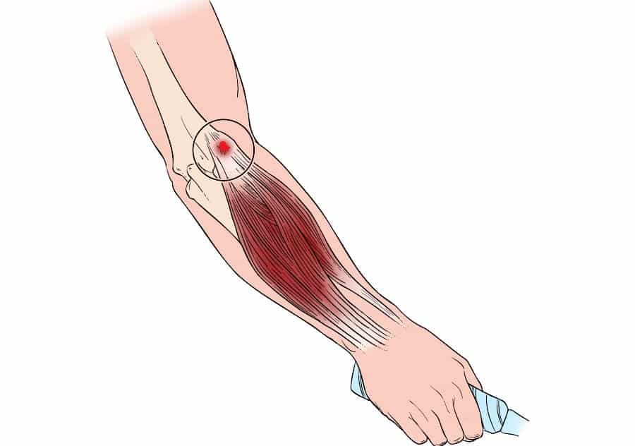 tennis elbow point-min