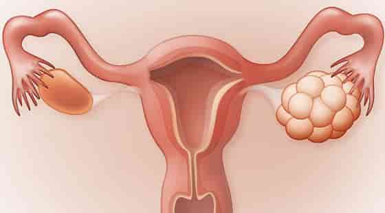 polycystic ovaries