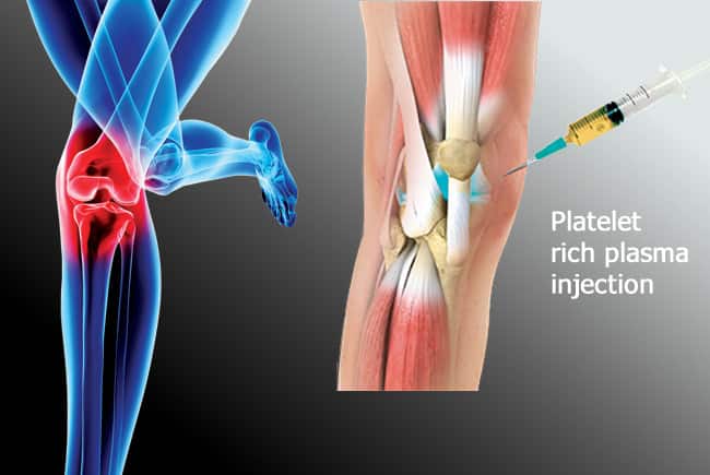 Medical graphic demonstrating Platelet-Rich Plasma PRP injection into the knee joint for osteoarthritis treatment