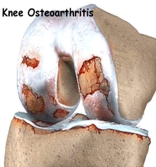 Knee osteoarthritis medical illustration showing severe cartilage wear and joint inflammation. Regenerative Therapy for Osteoarthritis knee.