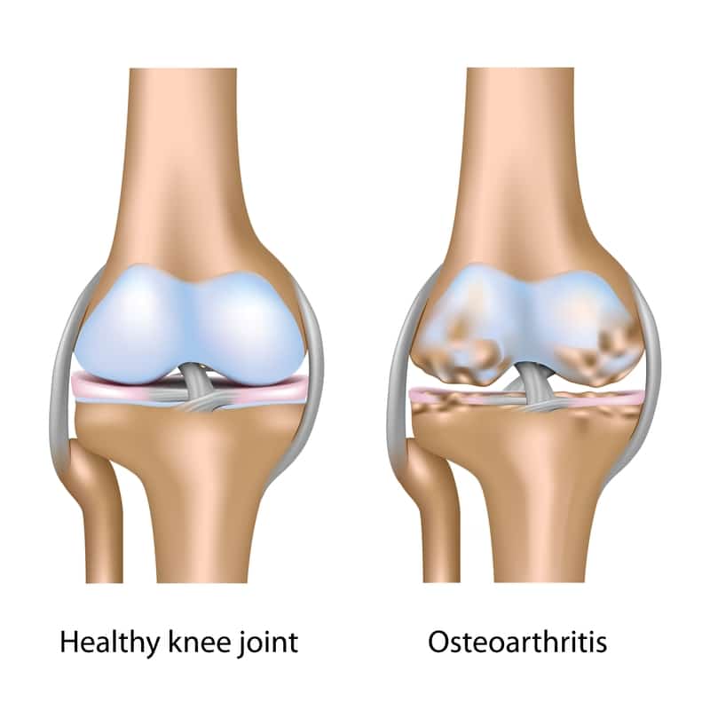 Medical diagram comparing a healthy knee joint with osteoarthritis knee joint showing cartilage wear and tear. Regenerative Therapy for Osteoarthritis knee.