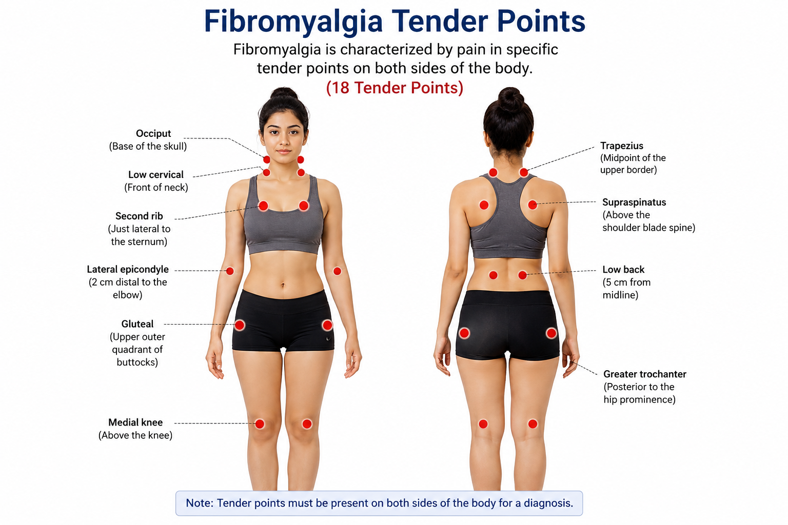 Fibromyalgia tender points diagram showing 18 pain sites front and back view