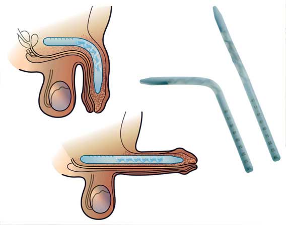 Medical illustration showing penile prosthesis implant placement for severe erectile dysfunction treatment.