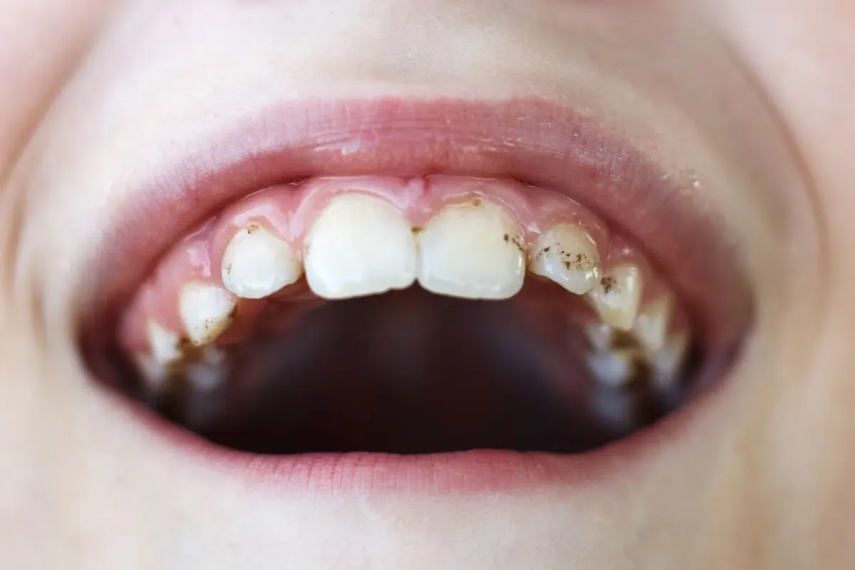 Close-up of human teeth showing signs of enamel erosion and tooth decay linked to Vitamin D deficiency
