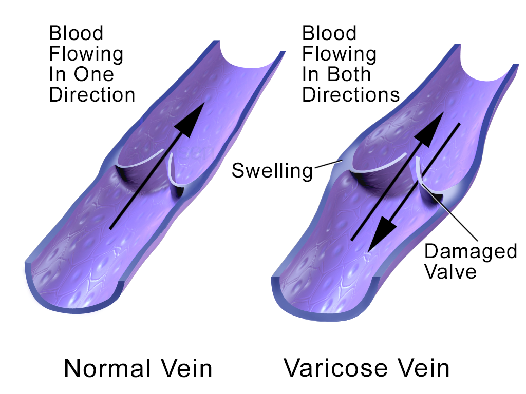 Diagram showing a leaking venous valve causing blood backflow and varicose vein formation